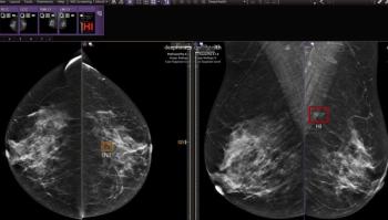 DeepHealth Unveils AI-Powered Breast Suite Mammography Software