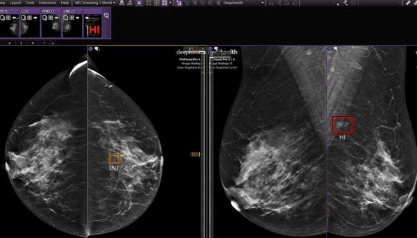 Mammography News: FDA Clears New Functionalities for DeepHealth’s AI-Powered Breast Suite 