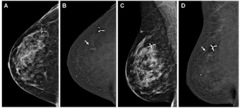 ECR Mammography Study: Pre-Op CEM Detects 34 Percent More Multifocal Masses than Mammography