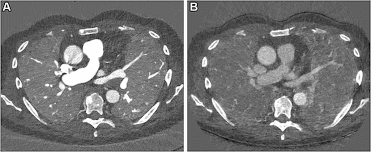Study Says Photon-Counting CT Offers Better Lung Assessment than Conventional CT