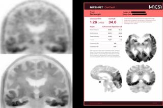 FDA Clears Software That Combines MRI Enhancement of PET Imaging with Automated Quantification of Amyloid and Tau PET