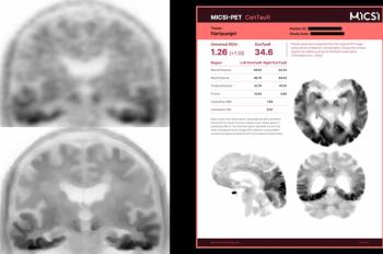 FDA Clears Software That Combines MRI Enhancement of PET Imaging with Automated Quantification of Amyloid and Tau PET