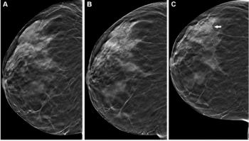 Large Study Shows Mixed Results in Comparison of DBT and Digital Mammography