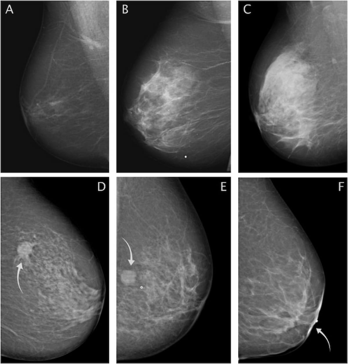 Un estudio de mamografía no encontró un vínculo significativo entre la densidad mamaria y el pronóstico del cáncer de mama