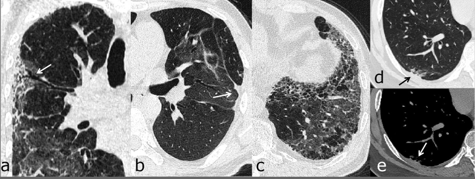 Post Covid 19 Ct Reveals Potentially Lifetime Lung Damage In One Thirds Of Patients