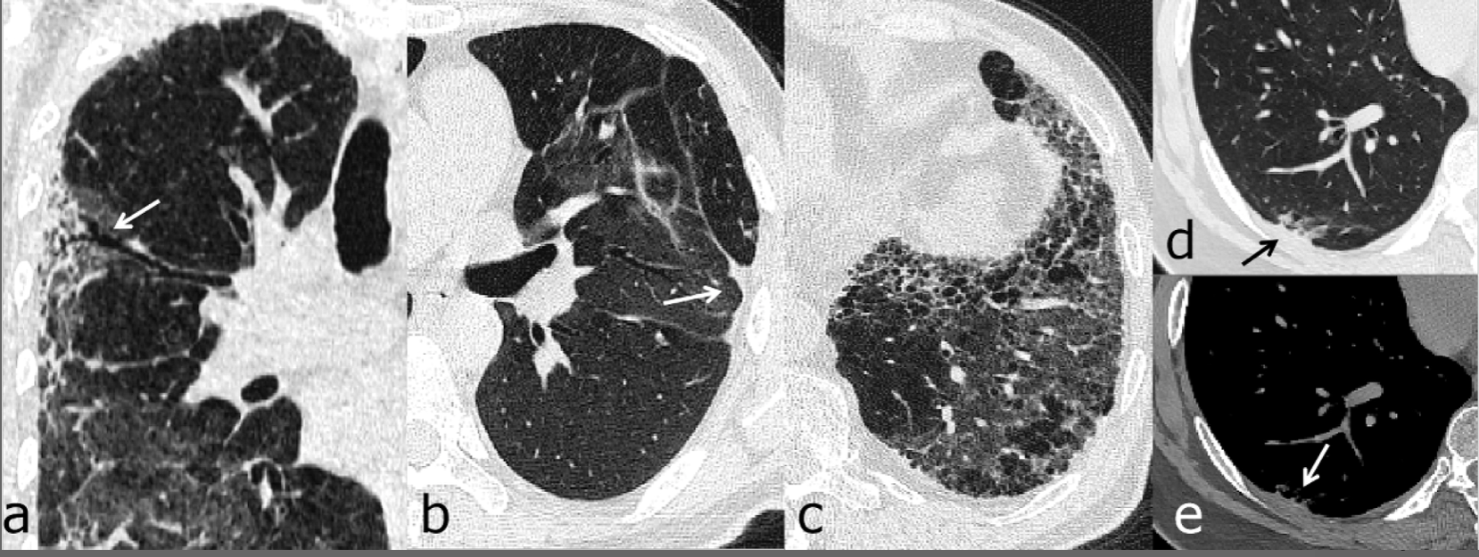 Post Covid 19 Ct Reveals Potentially Lifetime Lung Damage In One Thirds Of Patients Post Covid 19 Ct Reveals Potentially Lifetime Lung Damage In One Thirds Of Patients
