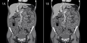 Vendors look to mathematical solutions to minimize CT dose, improve safety