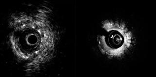 FDA Clears Hybrid System that Combines Intravascular Ultrasound with Optical Coherence Tomography
