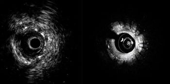 FDA Clears Hybrid System that Combines Intravascular Ultrasound with Optical Coherence Tomography