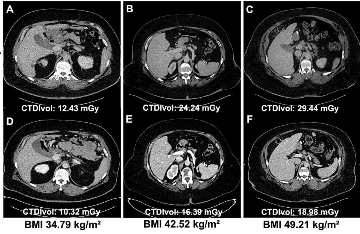 Study Shows PCCT Offers Higher Image Quality and Reduced Radiation Dosing than EID-CT in Obese Patients