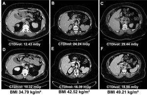 Study Shows PCCT Offers Higher Image Quality and Reduced Radiation Dosing than EID-CT in Obese Patients