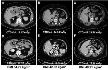 Study Shows PCCT Offers Higher Image Quality and Reduced Radiation Dosing than EID-CT in Obese Patients