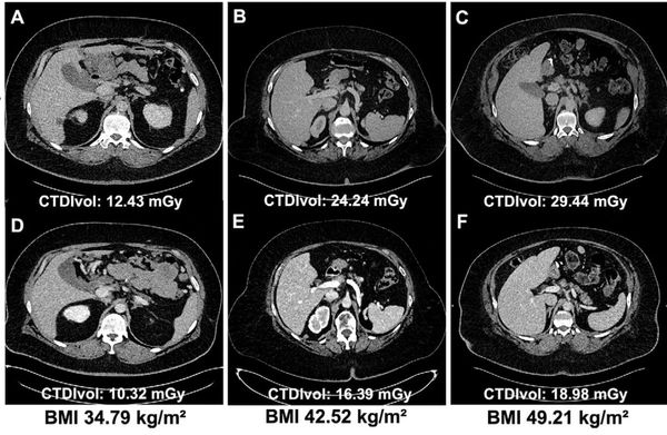 Study Shows PCCT Offers Higher Image Quality and Reduced Radiation Dosing than EID-CT in Obese Patients