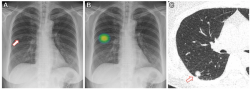 Study: AI More Than Doubles the Sensitivity Rate for Lung-RADS Category 4 Nodules on Chest X-Rays