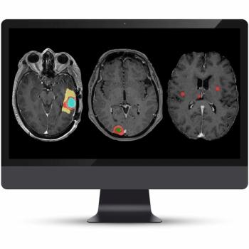 Updated MRI-Based AI Software Offers Automated Segmentation and Volumetric Reporting of Brain Metastases and Meningiomas