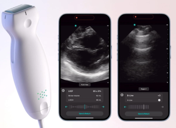 FDA Clears Cardiac and Lung AI Applications for Exo Iris Handheld Ultrasound