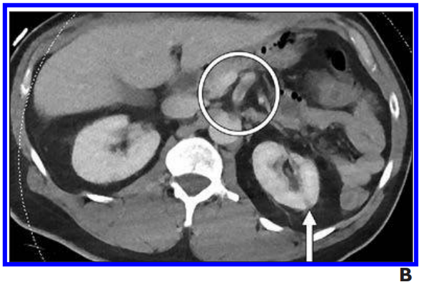 Ct Reveals Higher Abdominal And Pelvic Hypercoagulability In Covid 19