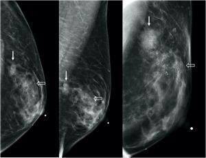 transgender breast imaging