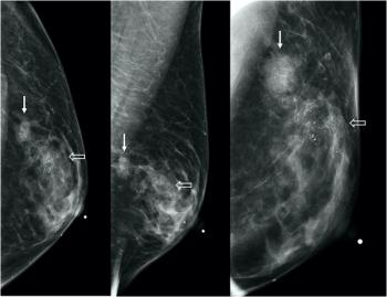 transgender breast imaging