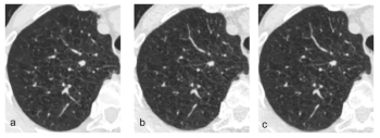 Can Deep Learning Bolster Image Quality with Low-Dose Lung CT?
