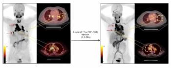SNMMI: Preliminary Research Suggests Dual-Targeting Radiopharmaceutical May Have Impact in Multiple Cancers