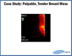 Palpable, Tender Breast Mass