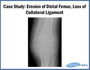 Erosion of Distal Femur, Loss of Collateral Ligament