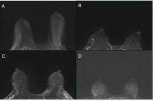 Breast MRI Study Suggests Black Women Are 31 Percent More Likely to Have High BPE 