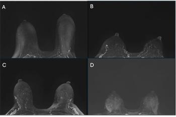 Breast MRI Study Suggests Black Women Are 31 Percent More Likely to Have High BPE 