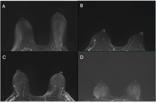 Breast MRI Study Suggests Black Women Are 31 Percent More Likely to Have High BPE