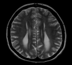 Scimitar Syndrome in Turner Syndrome