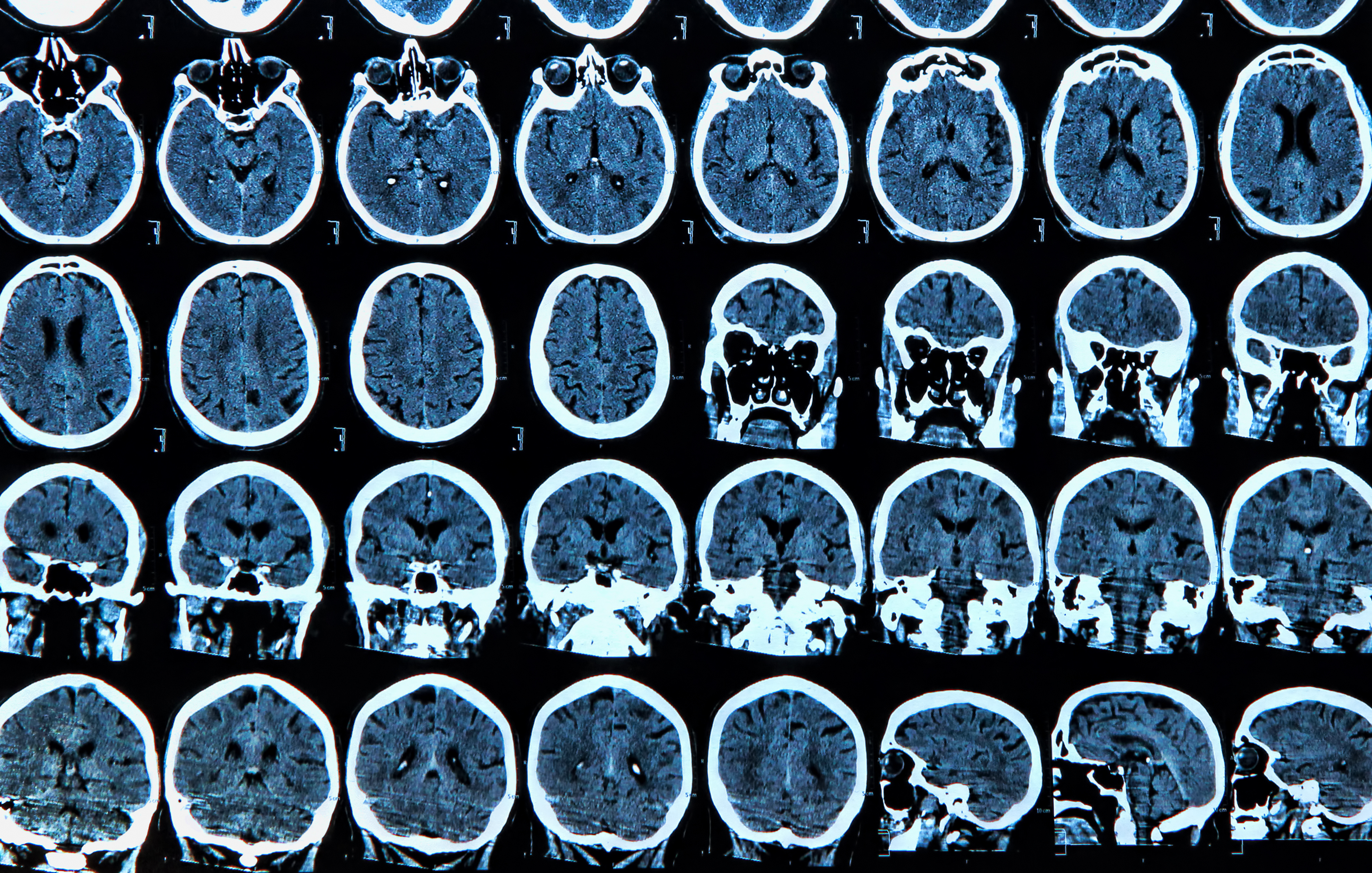 New Study Shows Link Between COVID-19 and Elevated Risks for Neurological Disorders - Diagnostic Imaging