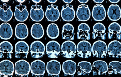 New Study Shows Link Between COVID-19 and Elevated Risks for Neurological Disorders