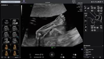 GE HealthCare Launches AI-Powered Voluson Performance 18 and 16 Ultrasound Systems
