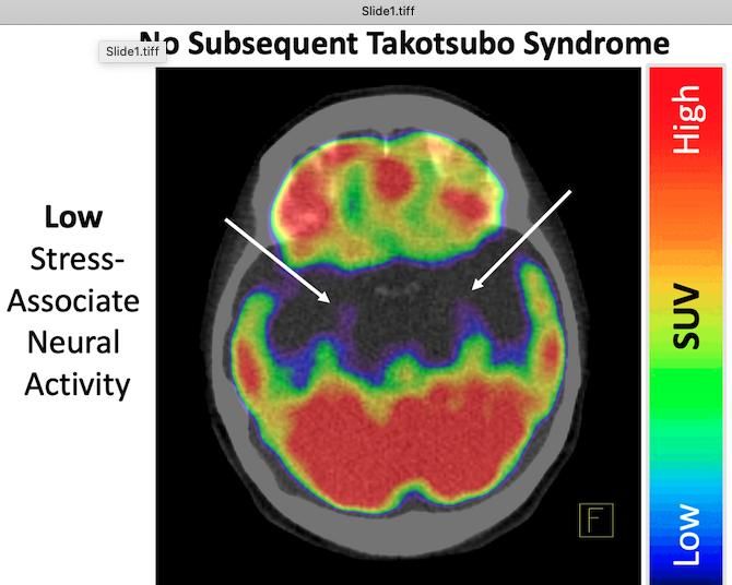 PET/CT Reveals Potential Link Behind Broken Heart Syndrome