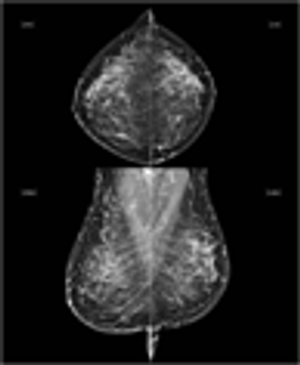 Legal Ramifications of Computer Aided Detection in Mammography