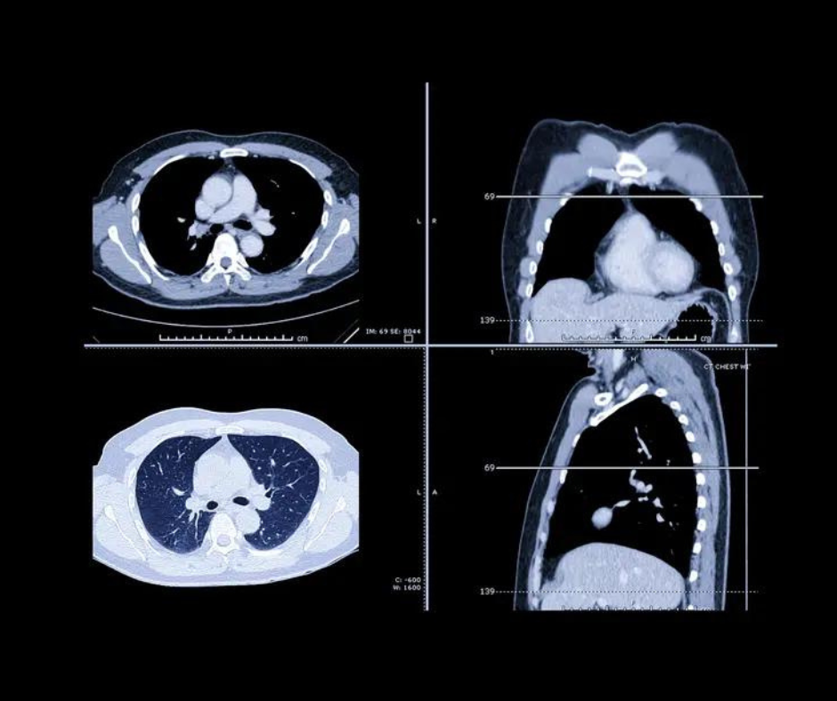 Seven Takeaways from Lung-RADS 2022 for CT Lung Cancer Screening