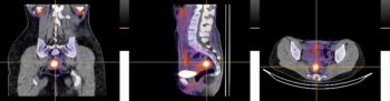 Emerging SPECT/CT Agent Gets FDA Fast Track Designation for Superficial Peritoneal Endometriosis