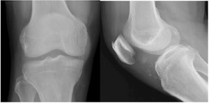 Extraskeletal Chondroma