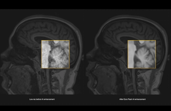 FDA Clears AI Software That May Lead to 30-Minute Full-Body MRI Exams