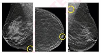 What a DBT Screening Study Reveals About False Positives with AI and Radiologist Assessments