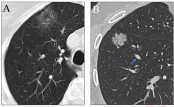 AI Adjudication Bolsters Chest CT Assessment of Lung Adenocarcinoma