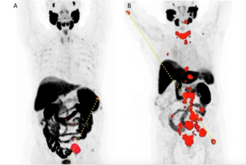 Study Examines Prognostic Value of Baseline PSMA PET/CT Factors in Patients with mCRPC