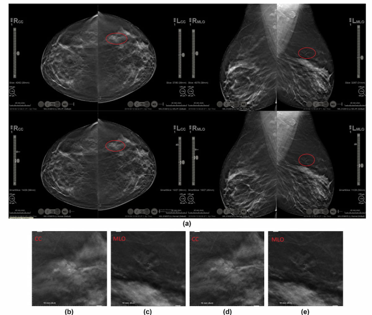 Mri Topic Mammography Study Reveals Nearly 13 Percent Reduction in Reading Time ...