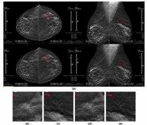 Mammography Study Reveals Nearly 13 Percent Reduction in Reading Time with AI-Powered Slab Reconstruction for DBT