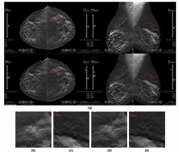 Mammography Study Reveals Nearly 13 Percent Reduction in Reading Time with AI-Powered Slab Reconstruction for DBT