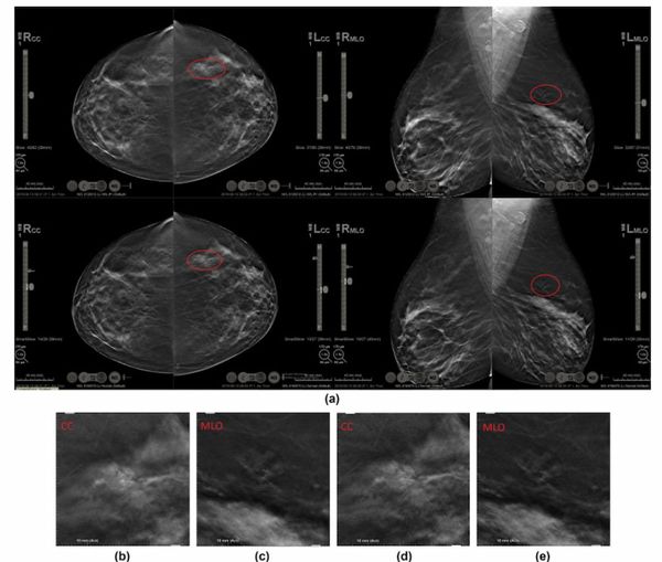 Mammography Study Reveals Nearly 13 Percent Reduction in Reading Time with AI-Powered Slab Reconstruction for DBT