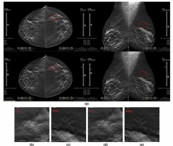 Mammography Study Reveals Nearly 13 Percent Reduction in Reading Time with AI-Powered Slab Reconstruction for DBT