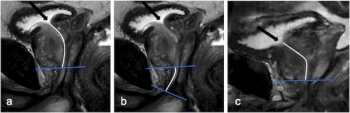 Can MRI Findings Help Predict Toxicity After Radiotherapy for Prostate Cancer?