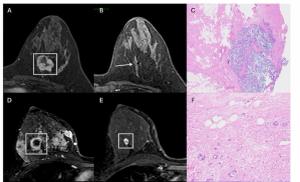 Study: MRI May Help Predict Outcomes in Treatment for Triple-Negative Breast Cancer